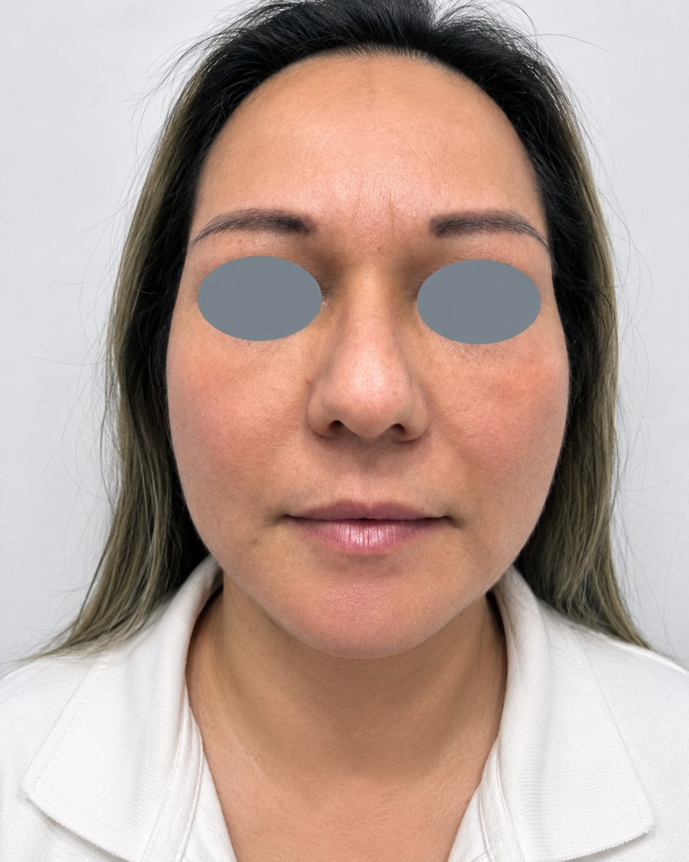 Depois do tratamento a laser